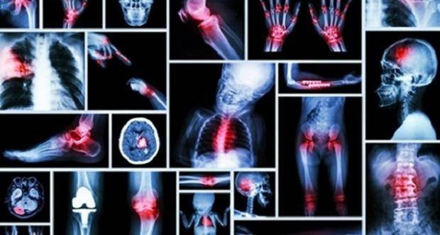 Las metástasis en el hígado del dolor en la espalda