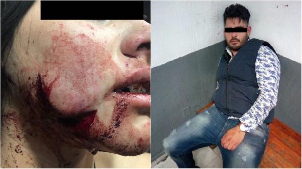 Hombre desfigura rostro de su novia en la Roma