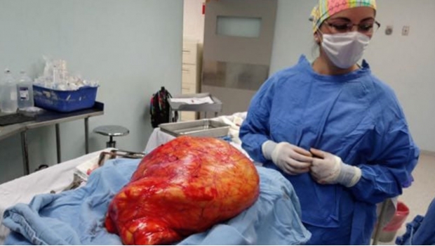Extirpa IMSS tumor abdominal de 17 kilos. Noticias en tiempo real